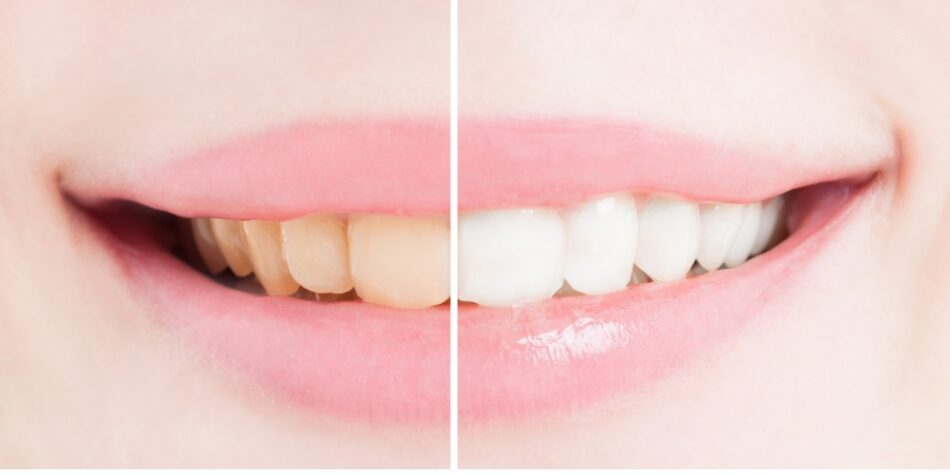 6 Natural Herbs That Help Whiten Teeth